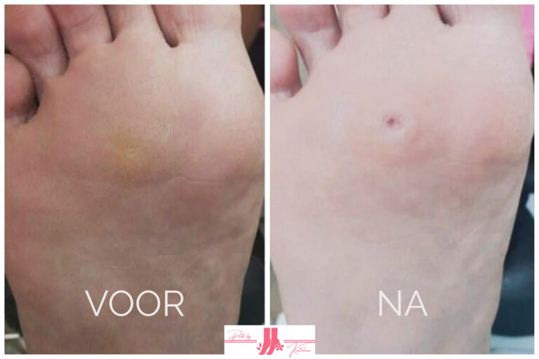 VOOR-NA